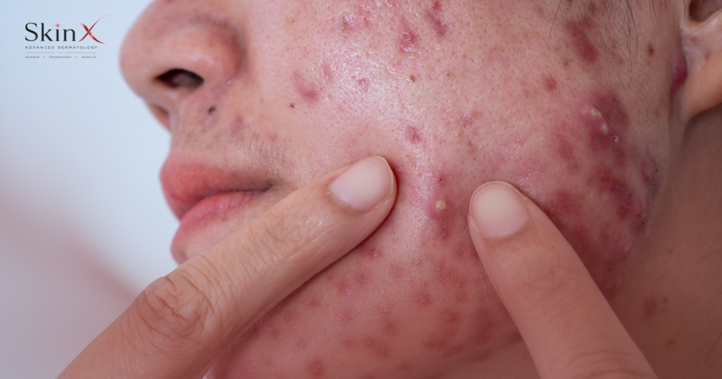 Da mụn có nên sử dụng kem chống nắng thường xuyên không?